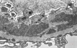 M,37y. | type I membranoproliferative glomerulonephritis (mesangiocapillary) M,37y. | type I membranoproliferative glomerulonephritis (mesangiocapillary)